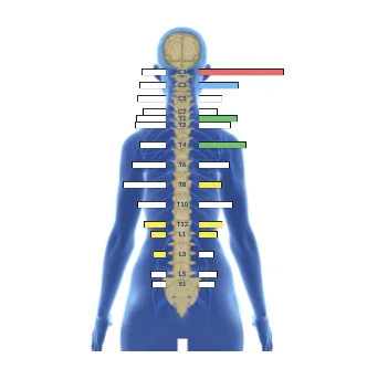 Chiropractic Park Ridge IL Alyssa's EMG Scan An EMG scan that shows stress points in the spine